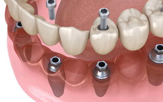 ¿Cuál es la mejor clínica para un implante dental en A Coruña?